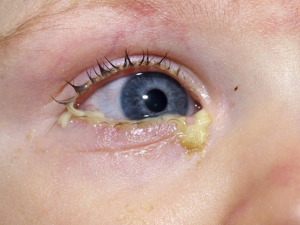 Thuốc nhỏ mắt trị đau mắt đỏ dùng thế nào mới hiệu quả?