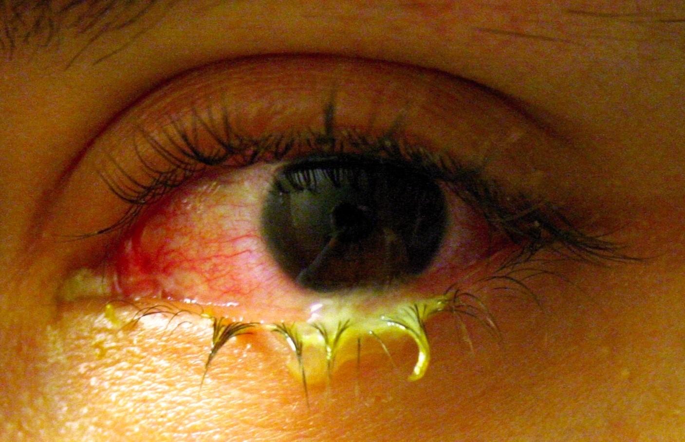 Đau mắt đỏ kiêng gì và tránh các loại thực phẩm nào?